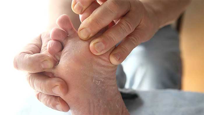 nuoc-an-chan-1 Luôn luôn giữ bàn chân được khô ráo.