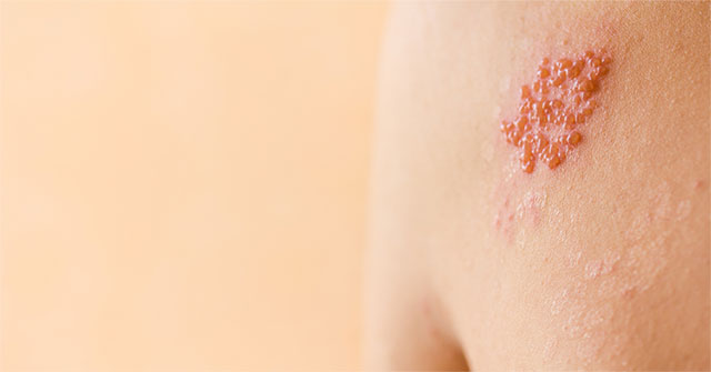 Hiểu Biết Về Bệnh Zona Thần Kinh: Triệu Chứng, Nguyên Nhân và Cách Điều Trị Hiệu Quả