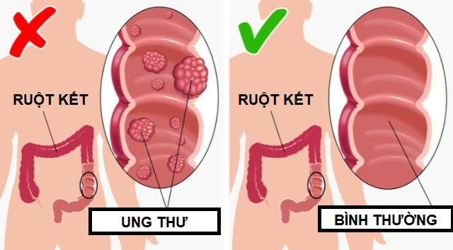 Giảm nguy cơ mắc bệnh ung thư