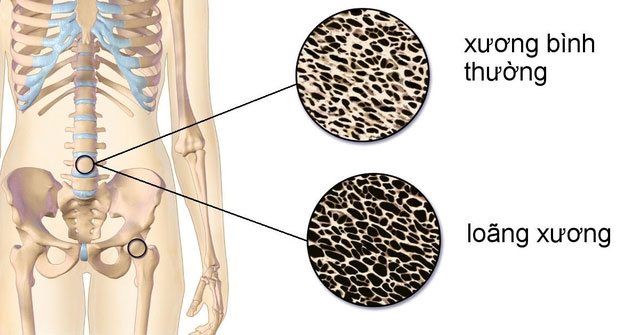 Những Thực Phẩm Cần Tránh Để Bảo Vệ Sức Khỏe Xương Khớp