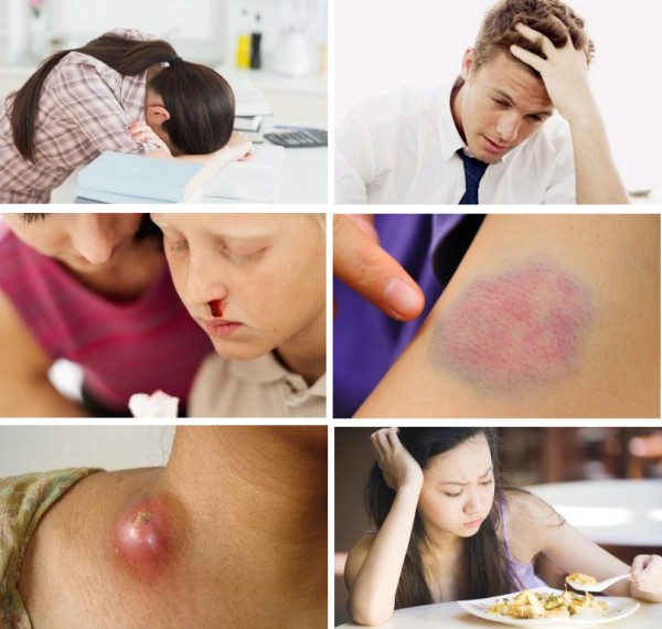 Ung thư máu Những điều cần biết về bệnh ung thư máu