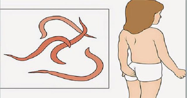 Cách bắt giun kim cho trẻ: nhận diện, rủi ro và phương án xử lý tại nhà